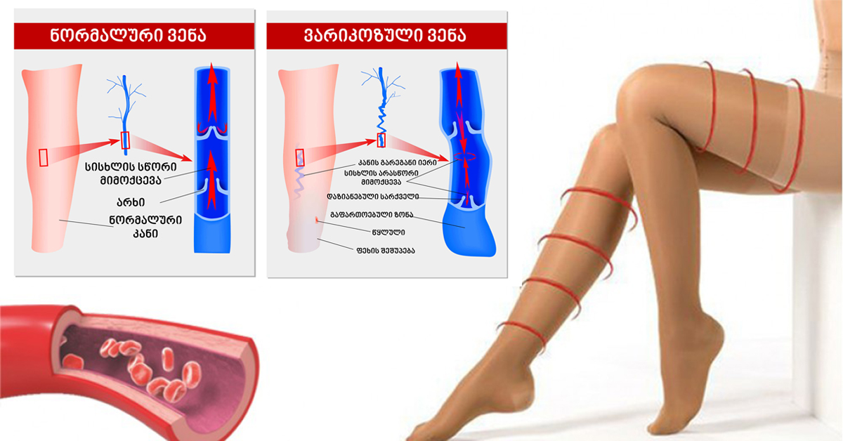 От вен на ногах